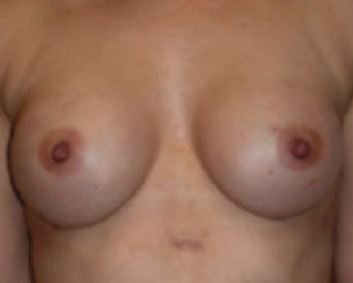 beforeafter15-100