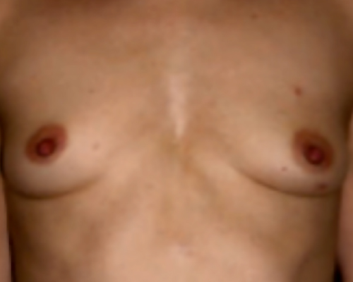 beforeafter16-100